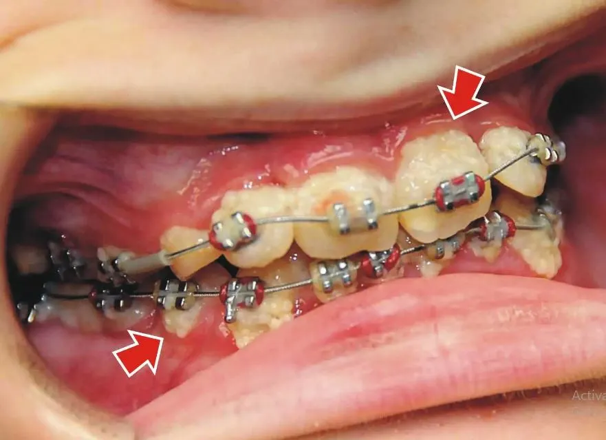 Braces Treatment